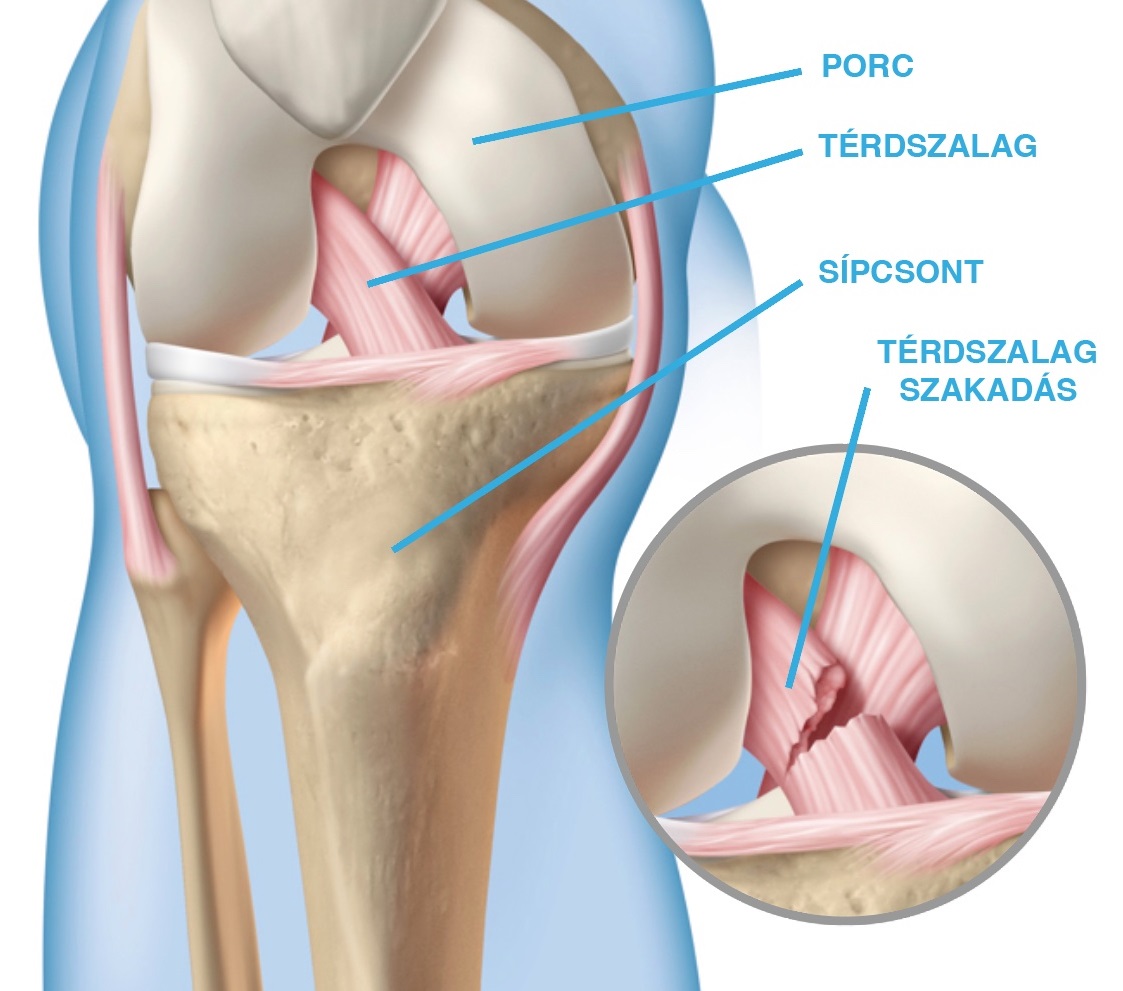 miért fáj a láb térdízülete a csípőízület 1 fokozatának artrózisa gyógyítható