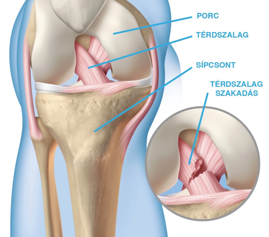a térd tünetei elülső keresztszalagjának károsodása ízületi ízületi program